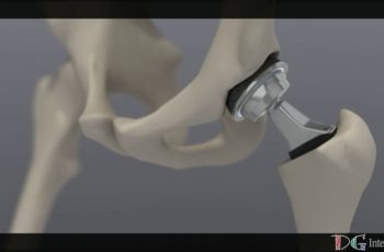 Replacement Hip D Animation DG Medical Animations
