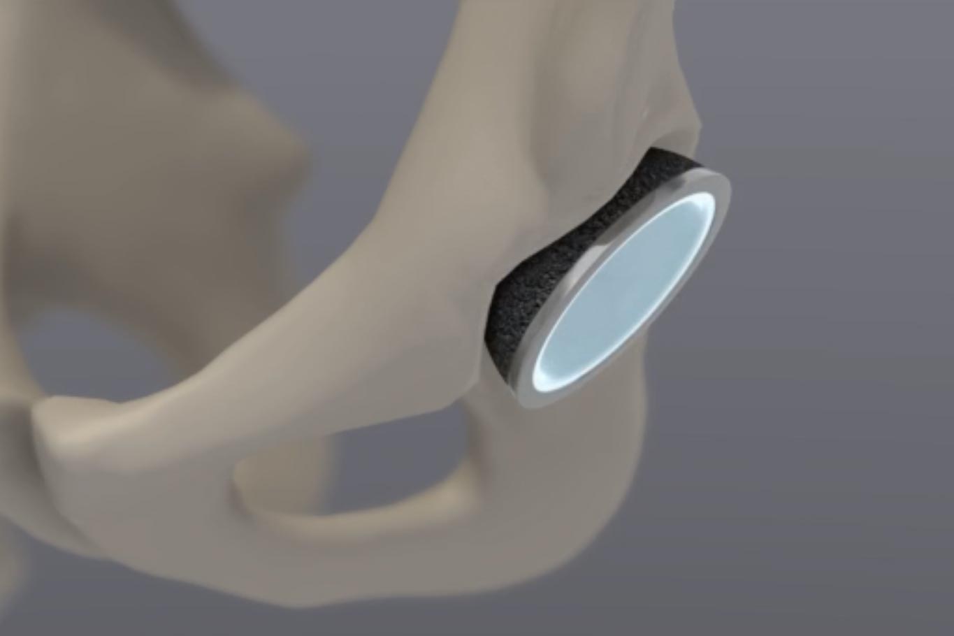 hip replacement surgery animation first step