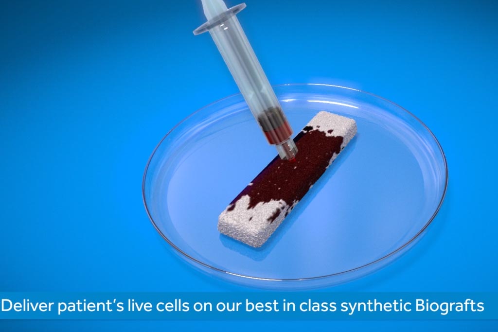 mastergraft by medtronic host cell biograft delivery d medical animation