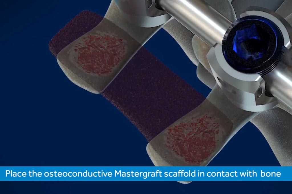 mastergraft by medtronic host cell recovery graft placement d medical animation
